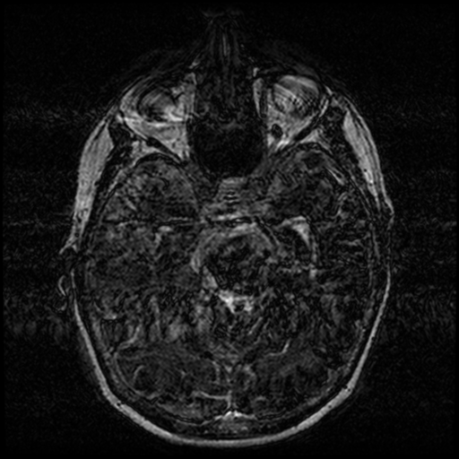 Angioinvasive aspergillosis in the pituitary fossa (Radiopaedia 39676-42010 Ax 3D FIESTA VOLUME 58).png