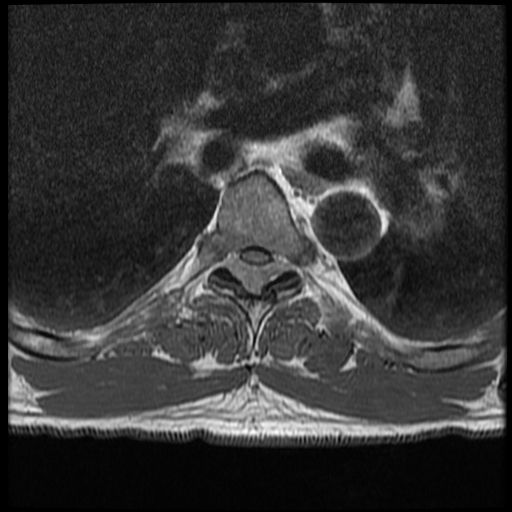 File:Angiolipoma - thoracic spine (Radiopaedia 28242-28479 Axial T1 16).jpg