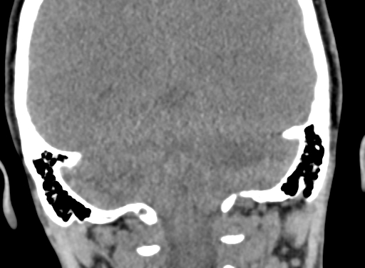 Angular dermoid cyst (Radiopaedia 88967-105790 Coronal non-contrast 91).jpg