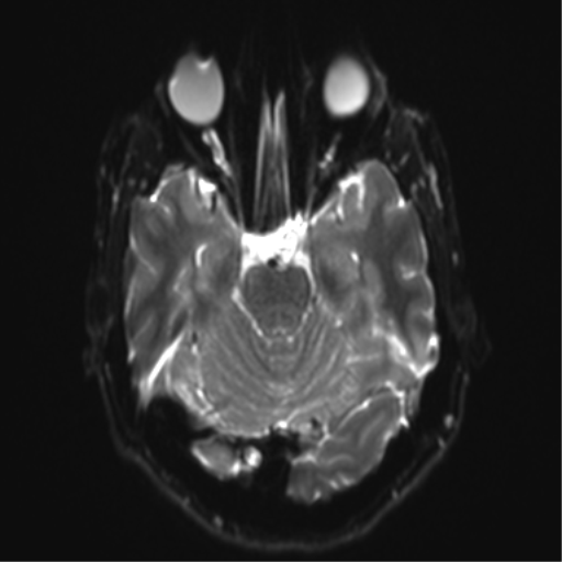 Angular epidermoid cyst (Radiopaedia 46908-51438 Axial DWI 27).png