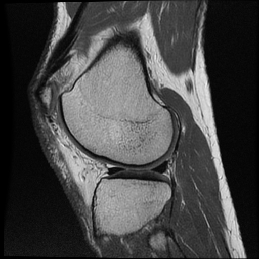 Anomalous insertion of the medial meniscus (Radiopaedia 77559-89721 Sagittal PD 17).jpg