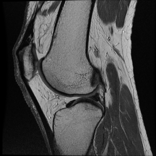 Anomalous insertion of the medial meniscus (Radiopaedia 77559-89721 Sagittal PD 22).jpg