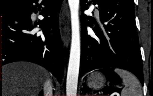 Anomalous left coronary artery from the pulmonary artery (ALCAPA) (Radiopaedia 70148-80181 B 245).jpg