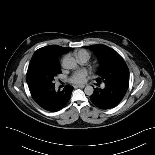 File:Anomalous origin of the left coronary artery with malignant course (Radiopaedia 77842-90126 Axial non-contrast 18).jpeg