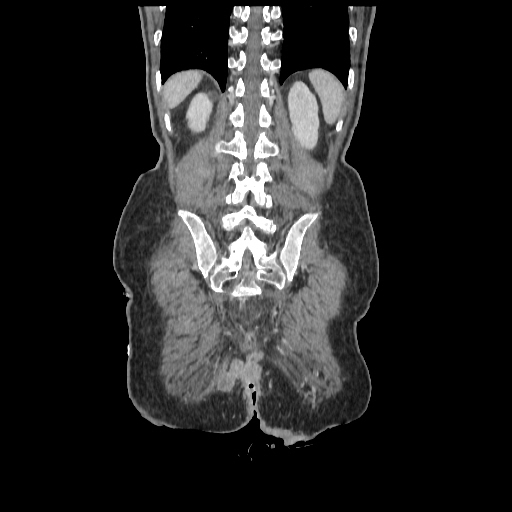 Anorectal carcinoma (Radiopaedia 44413-48064 B 74).jpg