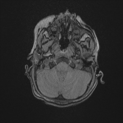 Anoxic brain injury (Radiopaedia 79165-92139 Axial MRA 37).jpg