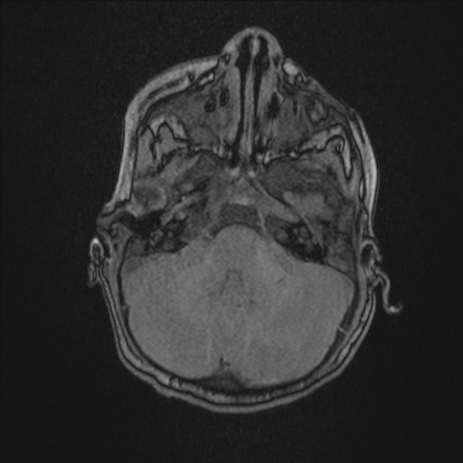 Anoxic brain injury (Radiopaedia 79165-92139 Axial MRA 49).jpg