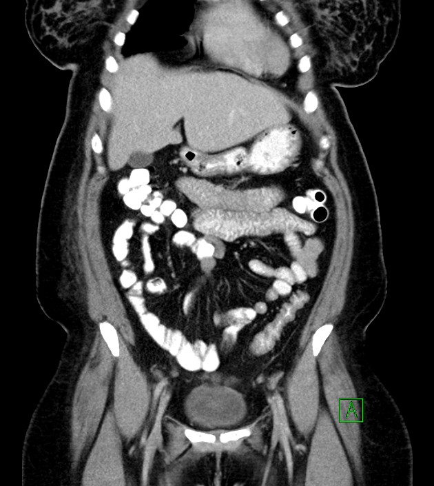 Anterior abdominal wall CSF pseudocyst (CSFoma) (Radiopaedia 79453-92571 B 20).jpg