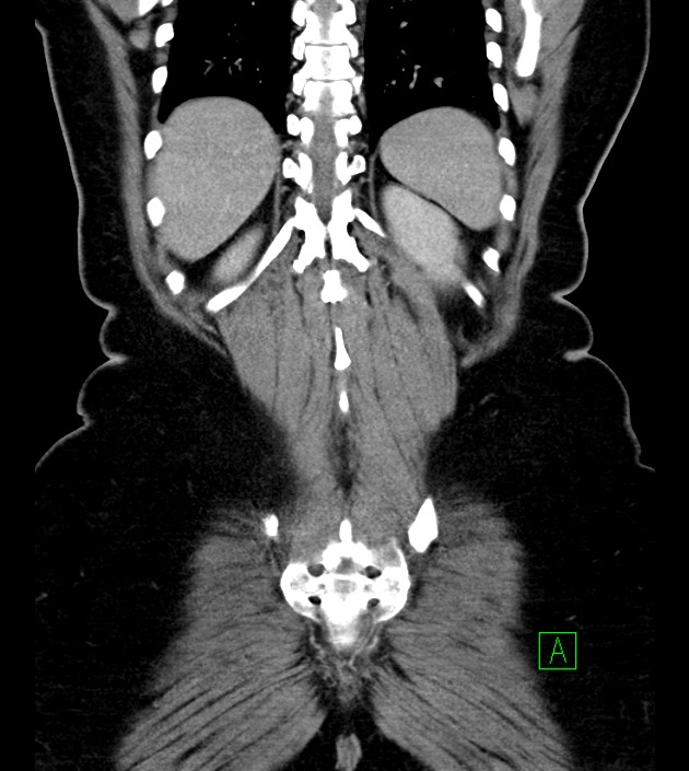 Anterior abdominal wall CSF pseudocyst (CSFoma) (Radiopaedia 79453-92571 B 46).jpg