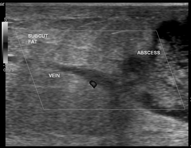 File:Anterior abdominal wall abscess (Radiopaedia 17732-17480 D 1).jpg