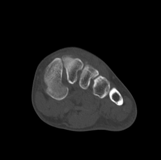 Anterior calcaneal process fracture (Radiopaedia 47384-51989 Coronal bone window 39).png