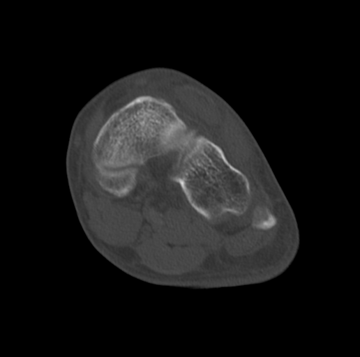 Anterior calcaneal process fracture (Radiopaedia 47384-51989 Coronal bone window 47).png