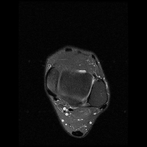 File:Anterior calcaneal process fracture (Radiopaedia 74654-85611 Axial PD fat sat 5).jpg