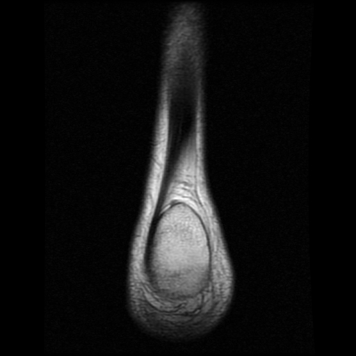 File:Anterior calcaneal process fracture (Radiopaedia 74654-85611 Coronal T1 27).jpg