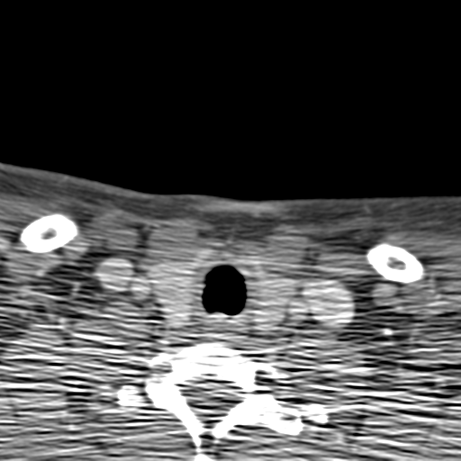 File:Anterior cerebral artery territory infarct (Radiopaedia 39327-41581 B 93).png