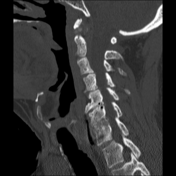 Anterior cervical postdiscectomy arthrodesis (Radiopaedia 32678-33646 Sagittal bone window 30).jpg