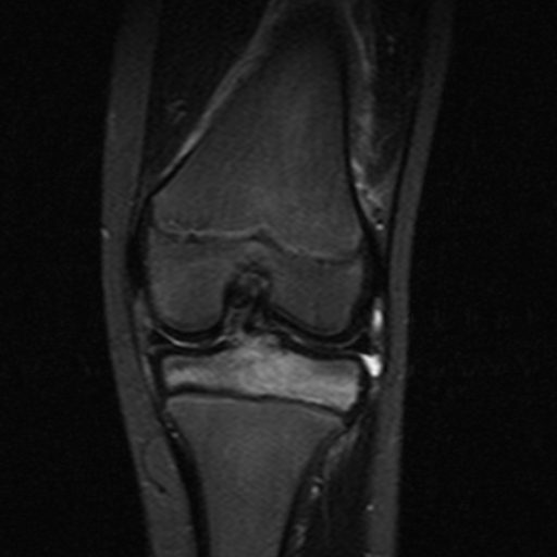 File:Anterior cruciate ligament avulsion fracture (Radiopaedia 24710-24974 Coronal STIR 7).jpg