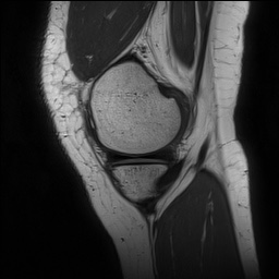 File:Anterior cruciate ligament rupture and posteromedial corner injury (Radiopaedia 67338-76723 Sagittal PD 40).jpg