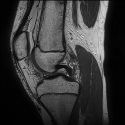 Anterior cruciate ligament tear - pediatric (Radiopaedia 62152-70260 Sagittal PD 78).jpg