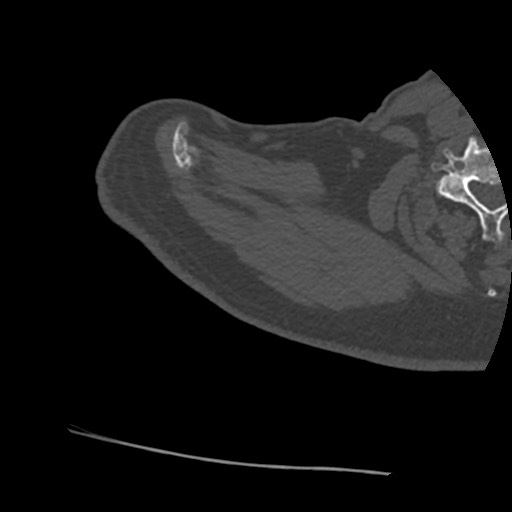 Anterior glenohumeral dislocation with Hill-Sachs lesion (Radiopaedia 62877-71249 Axial bone window 7).jpg
