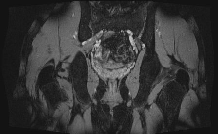 Anterior inferior iliac spine avulsion fracture (Radiopaedia 81312-95000 G 10).jpg