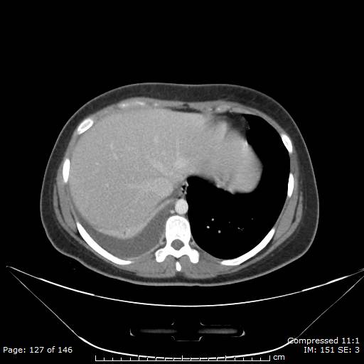 File:Anterior mediastinal B cell Lymphoma (Radiopaedia 50677-56114 A 64).jpg