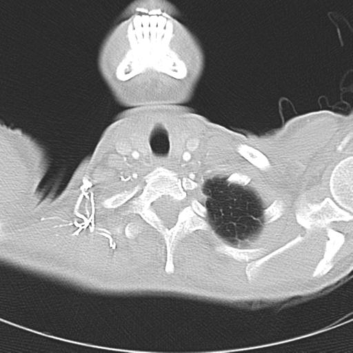 Anterior mediastinal lymphoma (Radiopaedia 29556-30061 Axial lung window 4).jpg
