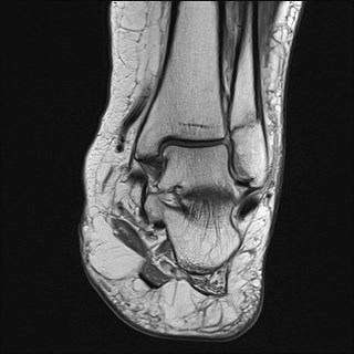File:Anterior talofibular ligament injury - rupture with soft-tissue impingement (Radiopaedia 38765-40928 Coronal PD 15).jpg