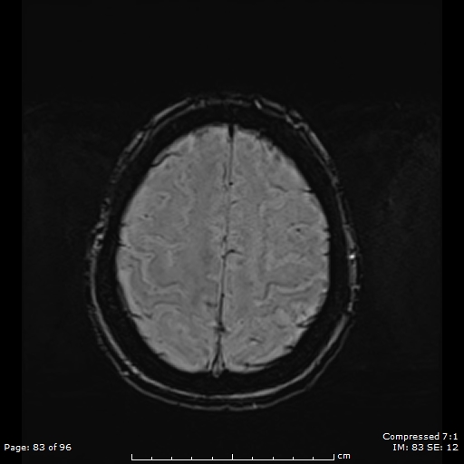 File:Anterior temporal lobe perivascular space (Radiopaedia 88283-104914 Axial SWI 52).jpg