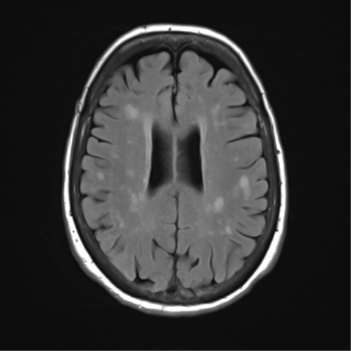 File:Anterior temporal pole cysts (Radiopaedia 46629-51102 Axial FLAIR 18).png
