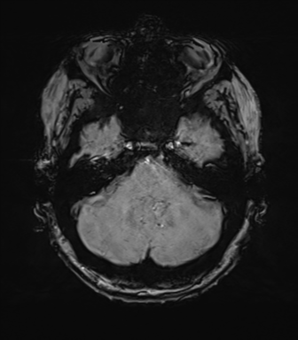 Anterior temporal pole cysts (Radiopaedia 46629-51102 Axial SWI 21).png
