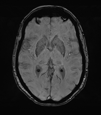 Anterior temporal pole cysts (Radiopaedia 46629-51102 Axial SWI 45).png