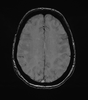 Anterior temporal pole cysts (Radiopaedia 46629-51102 Axial SWI 61).png