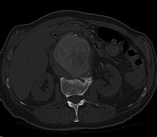 File:Anterior vertebral scalloping (abdominal aortic aneurysm) (Radiopaedia 66744-76067 Axial bone window 17).jpg