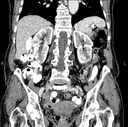 Aortic aneurysm and Lemmel syndrome (Radiopaedia 86499-102554 C 42).jpg
