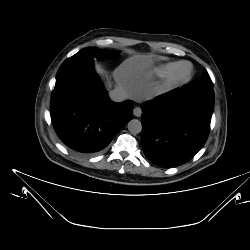 Aortic arch aneurysm (Radiopaedia 84109-99365 Axial non-contrast 220).jpg