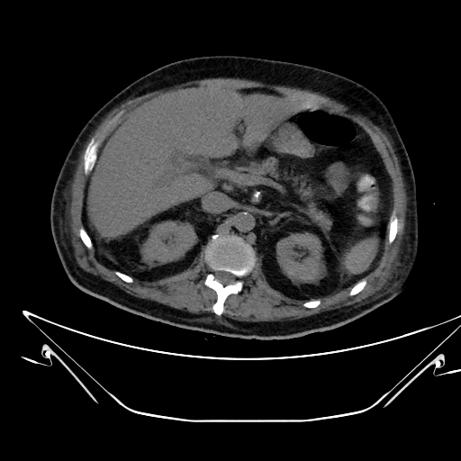 Aortic arch aneurysm (Radiopaedia 84109-99365 Axial non-contrast 299).jpg