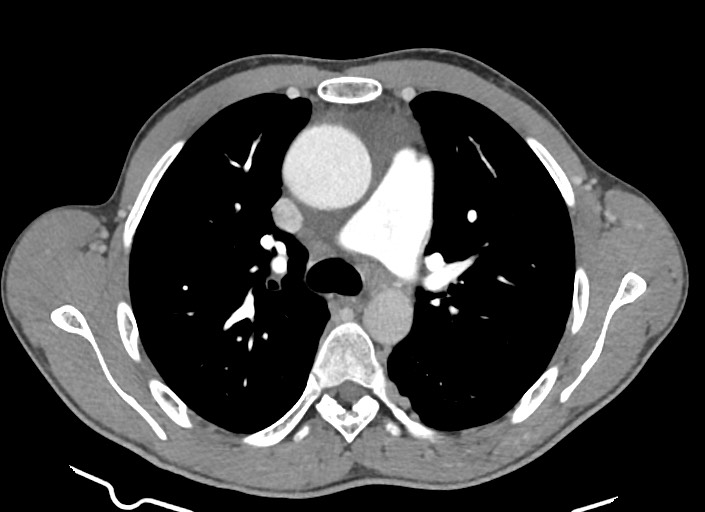 File:Aortic coarctation with aneurysm (Radiopaedia 74818-85828 A 131).jpg