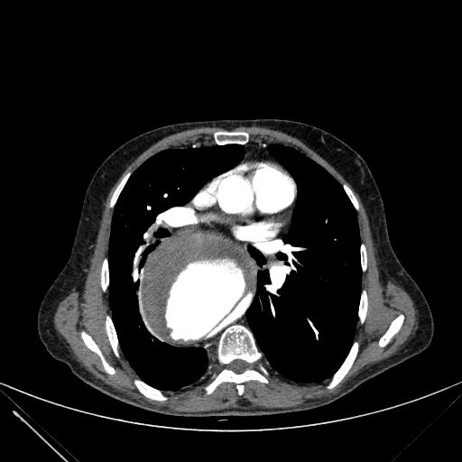 Aortic dissection (Radiopaedia 27466-27665 C+ arterial phase 129).jpg