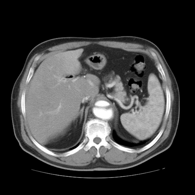 Aortic dissection (Radiopaedia 44411-48061 C 25).jpg