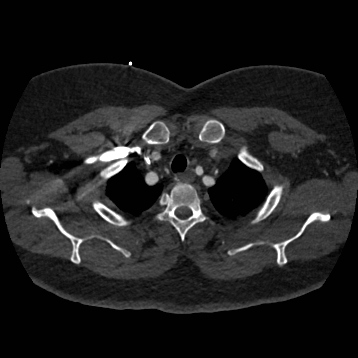 Aortic dissection (Radiopaedia 57969-64959 A 50).jpg