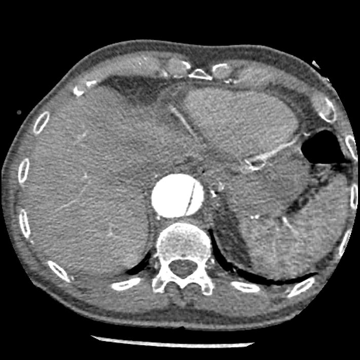 Aortic dissection - DeBakey Type I-Stanford A (Radiopaedia 79863-93115 A 34).jpg