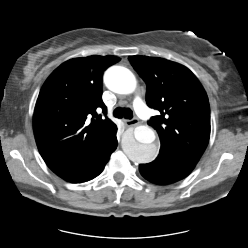 File:Aortic dissection - Stanford type B (Radiopaedia 50171-55512 A 18).png