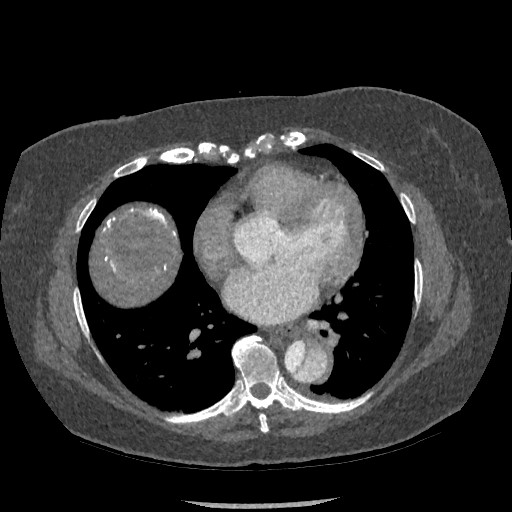 File:Aortic dissection - Stanford type B (Radiopaedia 88281-104910 A 55).jpg