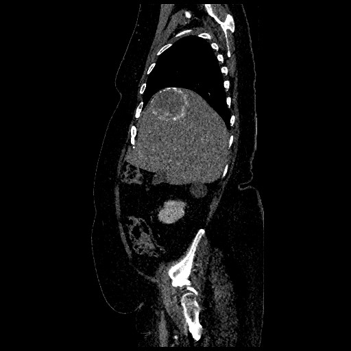 File:Aortic dissection - Stanford type B (Radiopaedia 88281-104910 C 14).jpg