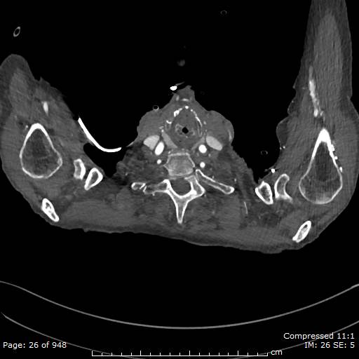 Aortic dissection with extension into aortic arch branches (Radiopaedia 64402-73204 B 26).jpg