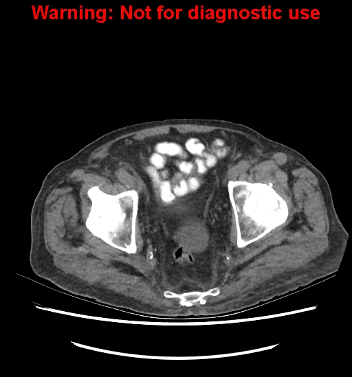 Aortic graft infection (Radiopaedia 44979-48907 Axial non-contrast 84).jpg