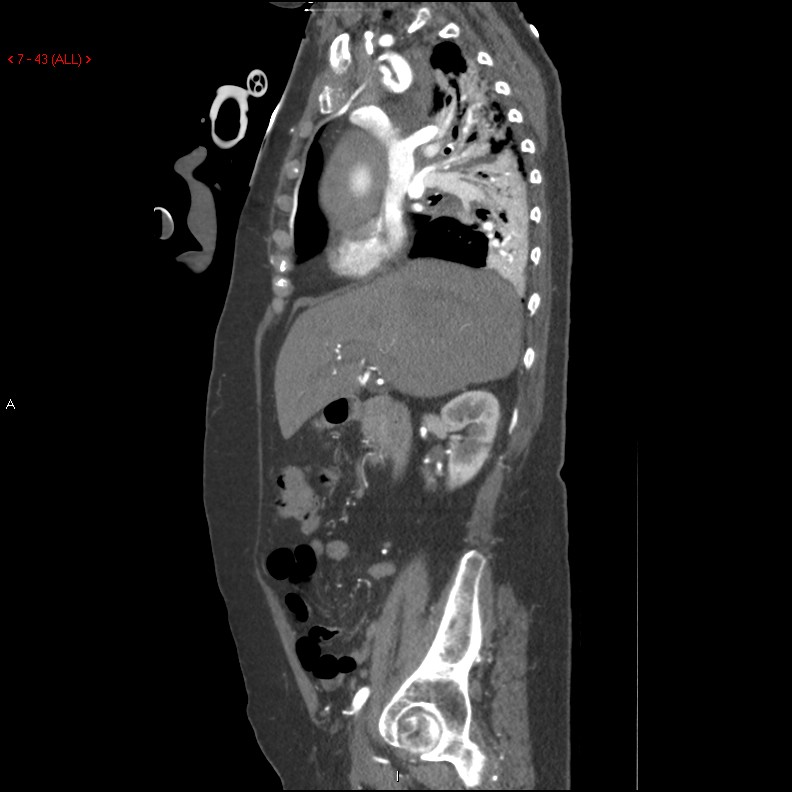 Aortic intramural hematoma (Radiopaedia 27746-28001 C 12).jpg
