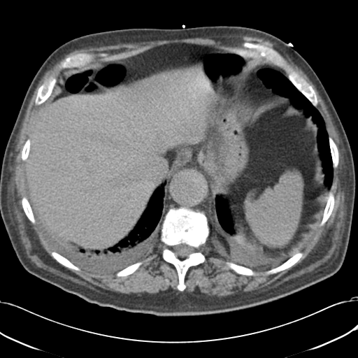 Aortic intramural hematoma (Radiopaedia 34260-35540 Axial non-contrast 53).png