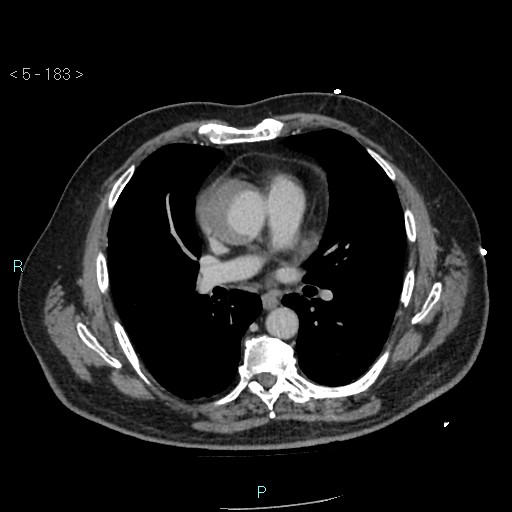 Aortic intramural hematoma (Radiopaedia 48463-53380 C 83).jpg
